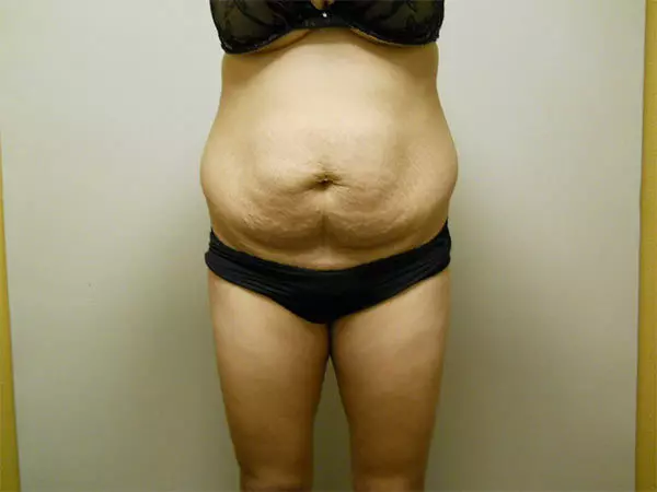 Liposuction Patient 06 Before 1