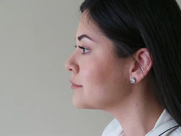 Liposuction Patient 09 After 1