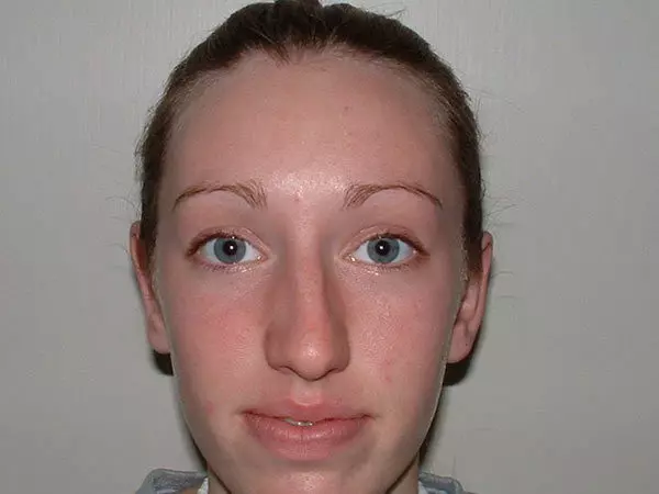 Otoplasty Patient 02 After 1