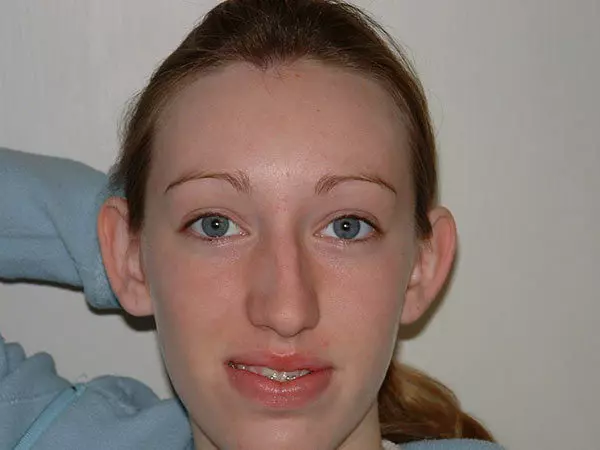Otoplasty Patient 02 Before 1