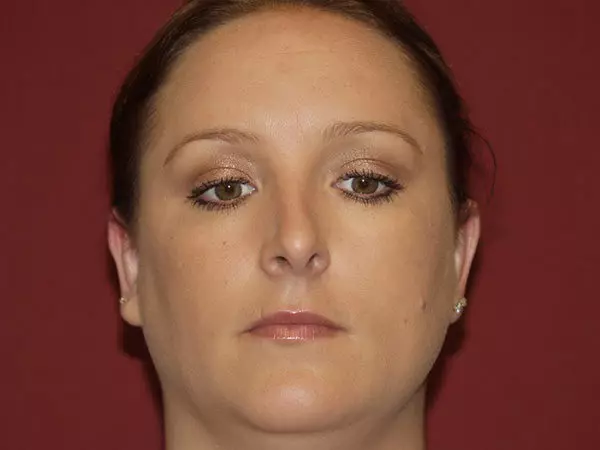 Otoplasty Patient 03 After 1