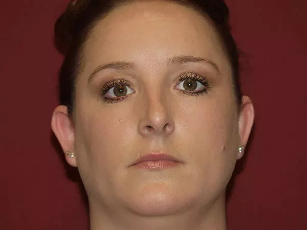 Otoplasty Patient 03 Before 1