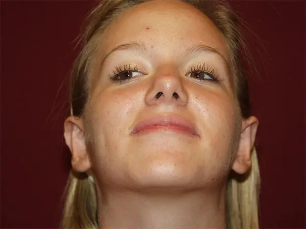 Otoplasty Patient 04 After 2