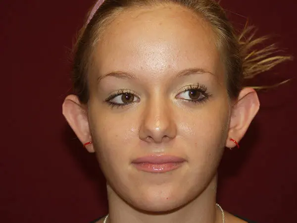 Otoplasty Patient 04 Before 1