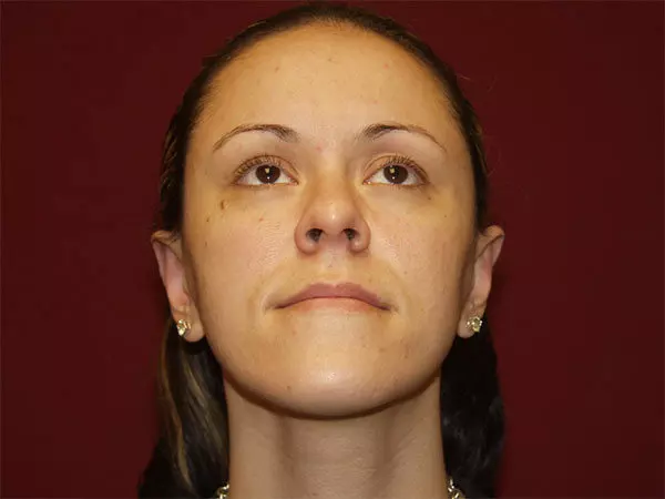 Otoplasty Patient 05 After 2