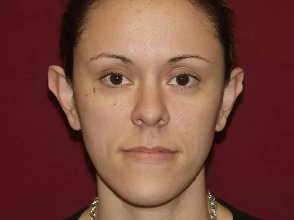 Otoplasty Patient 05 Before 1