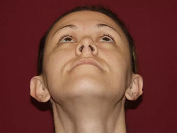 Otoplasty Patient 05 Before 2