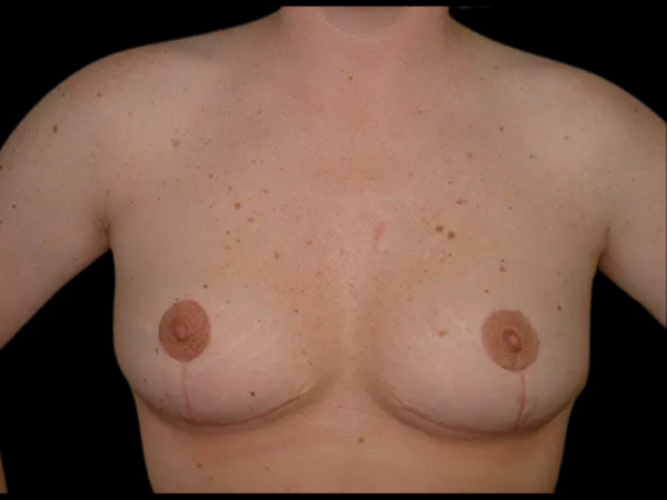 Breast Reduction Patient 10 After 1