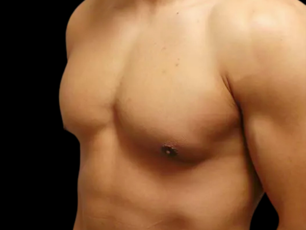Gynecomastia Patient 07 After 2