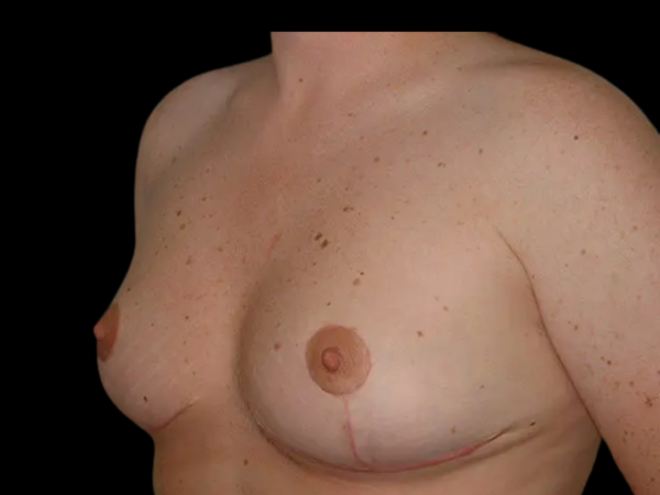 Breast Reduction Patient 10 After 2