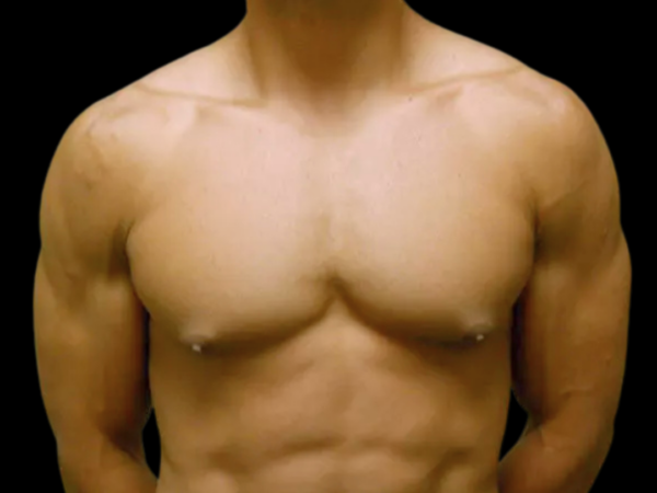 Gynecomastia Patient 07 Before 1