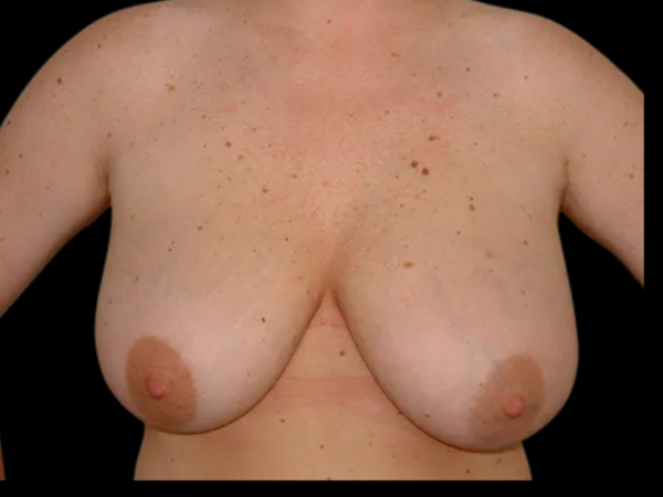 Breast Reduction Patient 10 Before 1