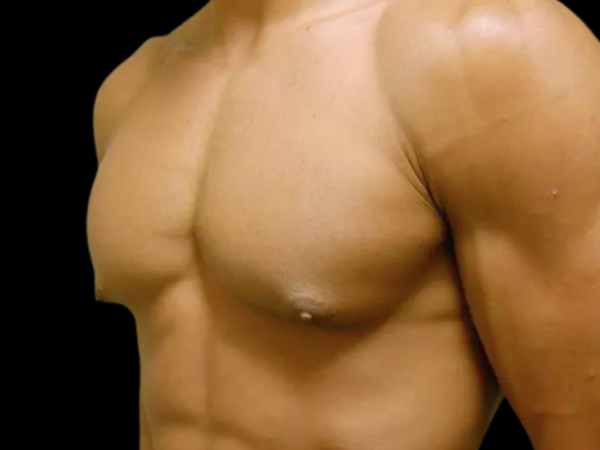 Gynecomastia Patient 07 Before 2