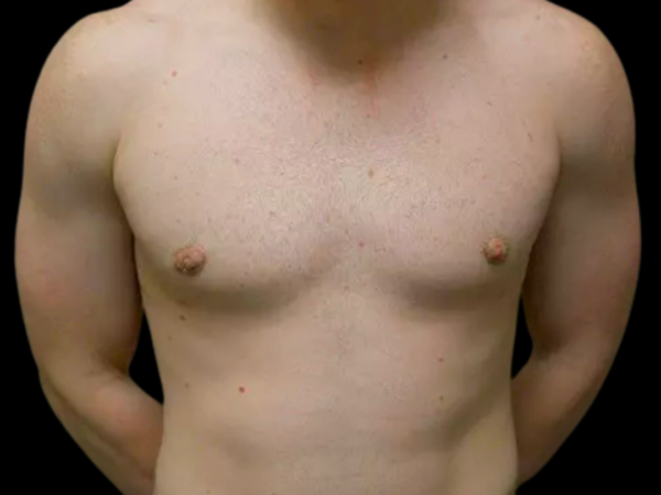 Gynecomastia Patient 08 After 1