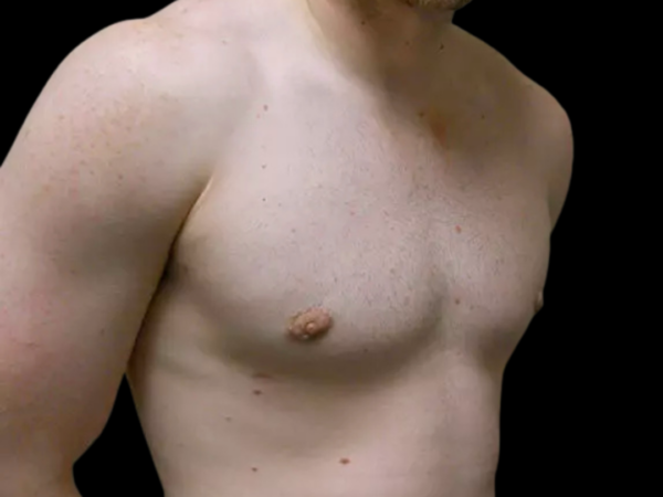 Gynecomastia Patient 08 After 2