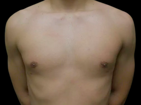 Gynecomastia Patient 09 After 1