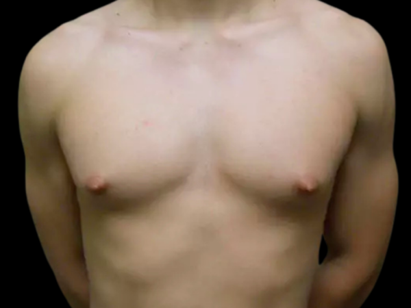 Gynecomastia Patient 09 Before 1
