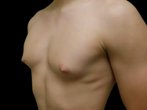 Gynecomastia Patient 09 Before 2
