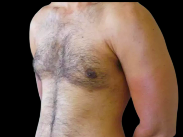 Gynecomastia Patient 10 After 2