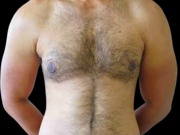 Gynecomastia Patient 10 After 1