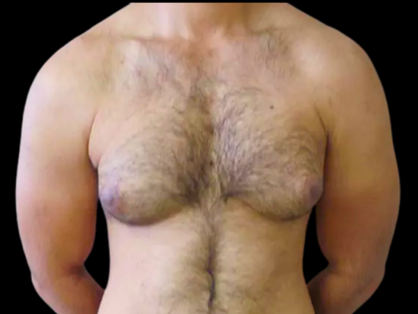 Gynecomastia Patient 10 Before 1