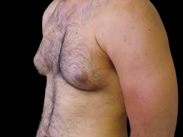 Gynecomastia Patient 10 Before 2