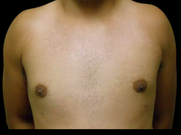 Gynecomastia Patient 11 After 1