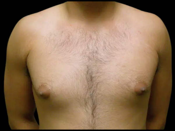 Gynecomastia Patient 11 Before 1