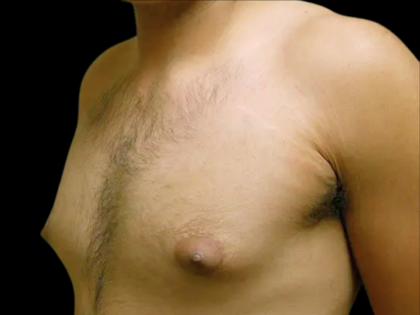 Gynecomastia Patient 11 Before 2