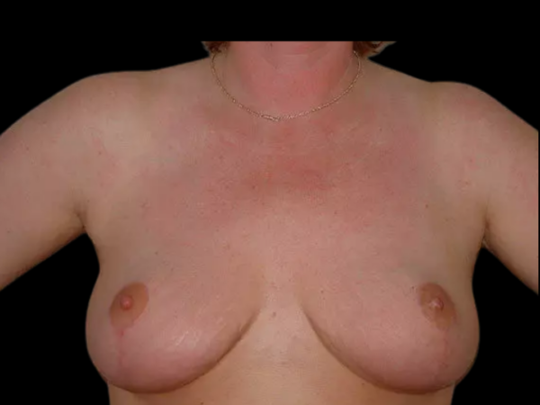 Breast Reduction Patient 15 After 1
