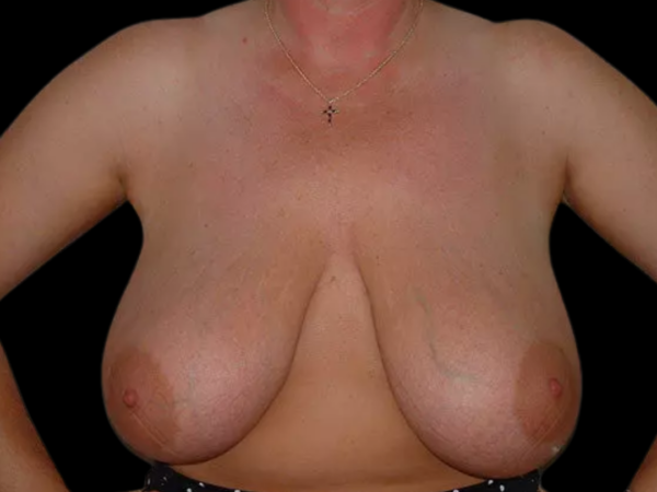 Breast Reduction Patient 15 Before 1
