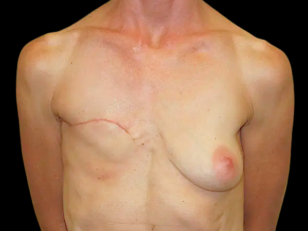 Breast Reconstruction Patient 01 Before 1