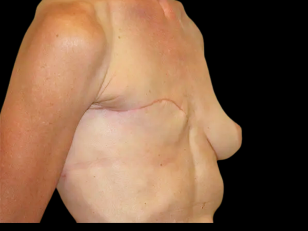 Breast Reconstruction Patient 01 Before 2