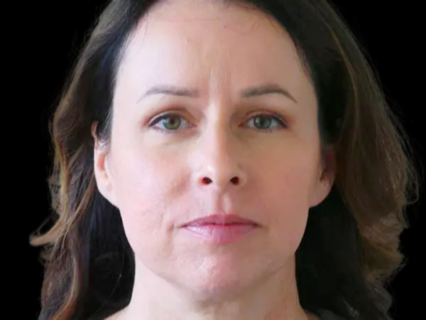 Eyelid Surgery Patient 01 After 2