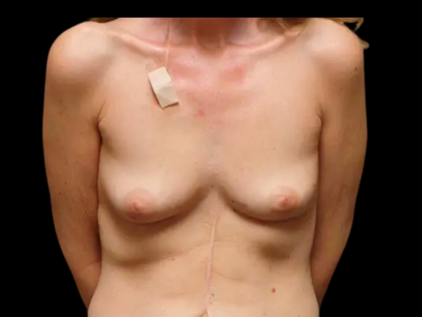 BREAST RECONSTRUCTION PATIENT 02 Before 1