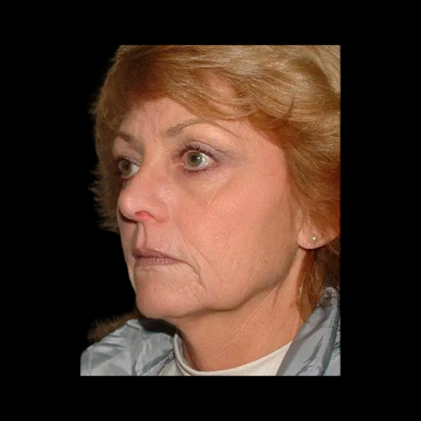 FaceLift Patient 16 Before 1