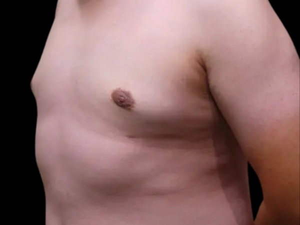 Gynecomastia #7028 After 1
