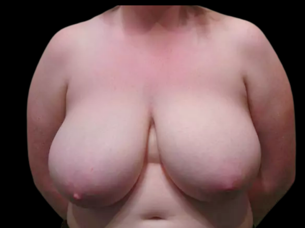 Breast Reduction Patient 03 Before 1