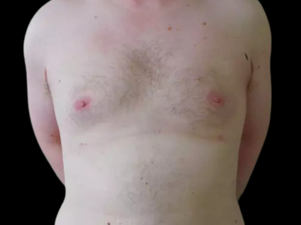 Gynecomastia Patient 03 After 1