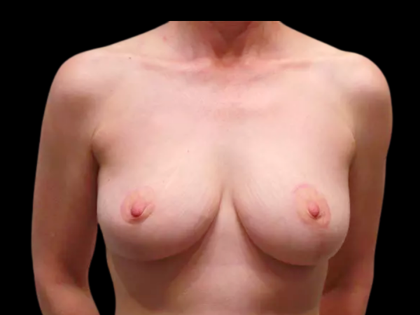 Breast Reduction Patient 04 After 1