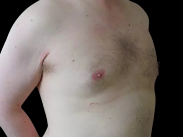 Gynecomastia Patient 03 After 2