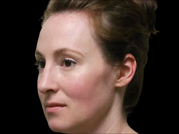 Rhinoplasty Patient 50 After 2