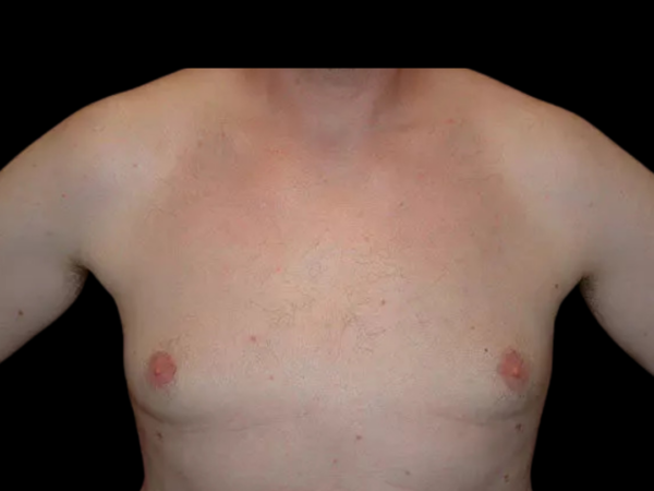 Gynecomastia Patient 04 After 1
