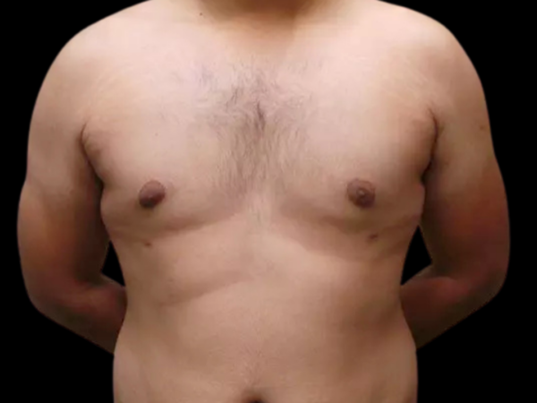 Gynecomastia #687 After 1