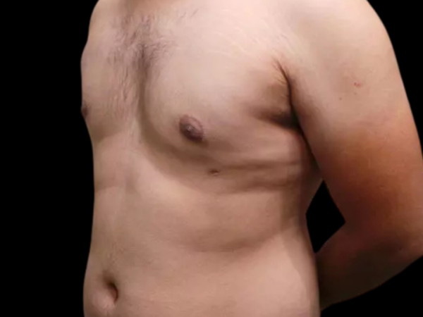 Gynecomastia #687 After 2