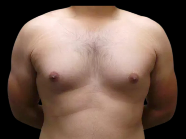 Gynecomastia #687 Before 1