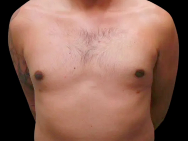 Gynecomastia Patient 06 After 1