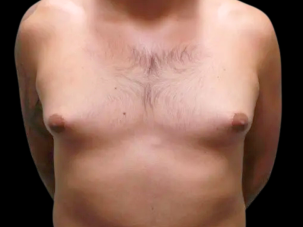 Gynecomastia Patient 06 Before 1