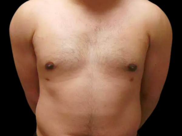 Gynecomastia Patient 05 After 1