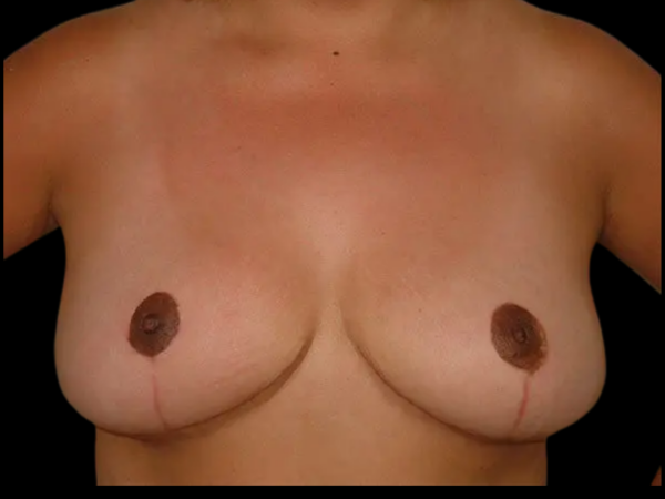 Breast Reduction Patient 08 After 1